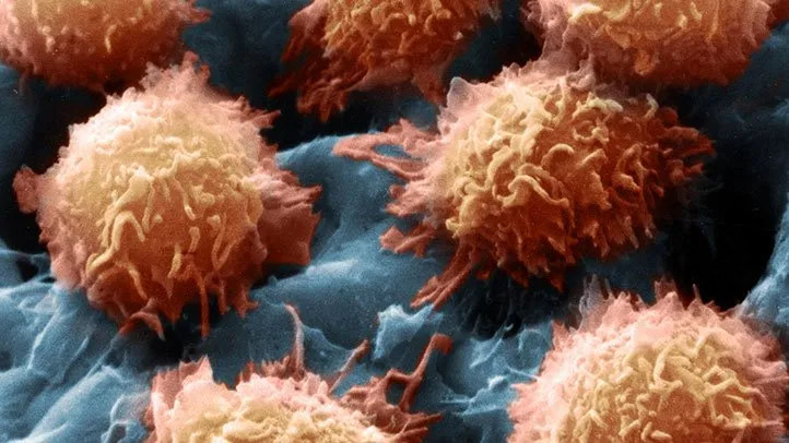hairy cell leukemia