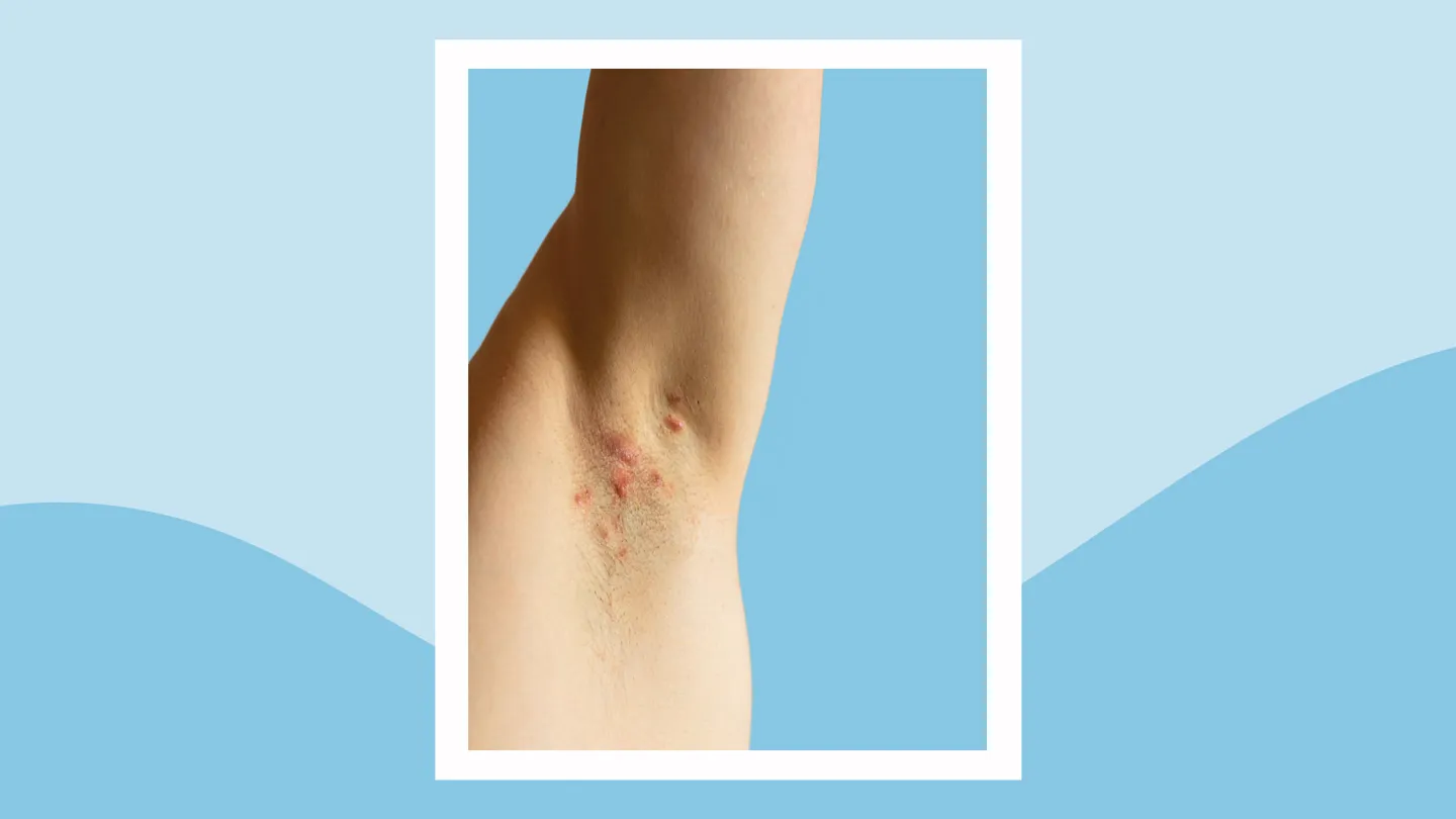 Hidradenitis-Suppurativa armpit