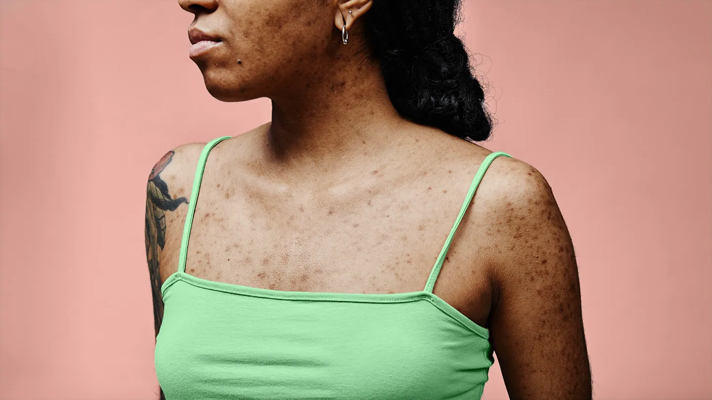 woman with hyperpigmentation