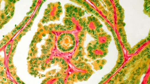 What Is Adenocarcinoma? Types, Causes, and Treatment