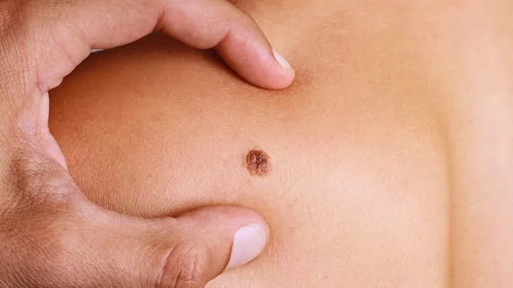a person with melanoma on their skin