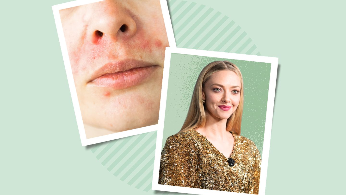 close-up of a face with Perioral Dermatitis and Amanda Seyfried