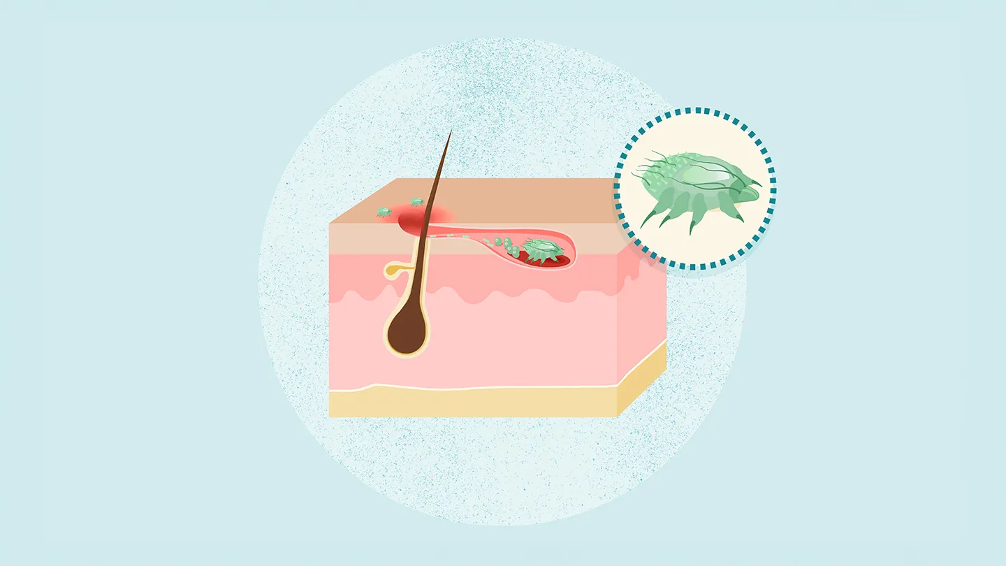 illustration of skin follicle and scabies and mite on blue