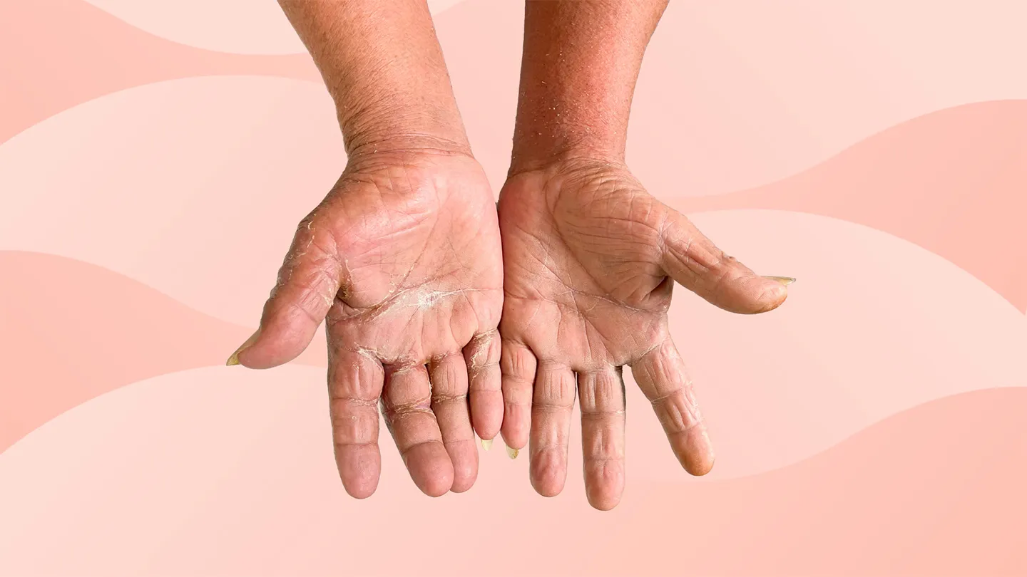 hands with scleroderma autoimmune disease