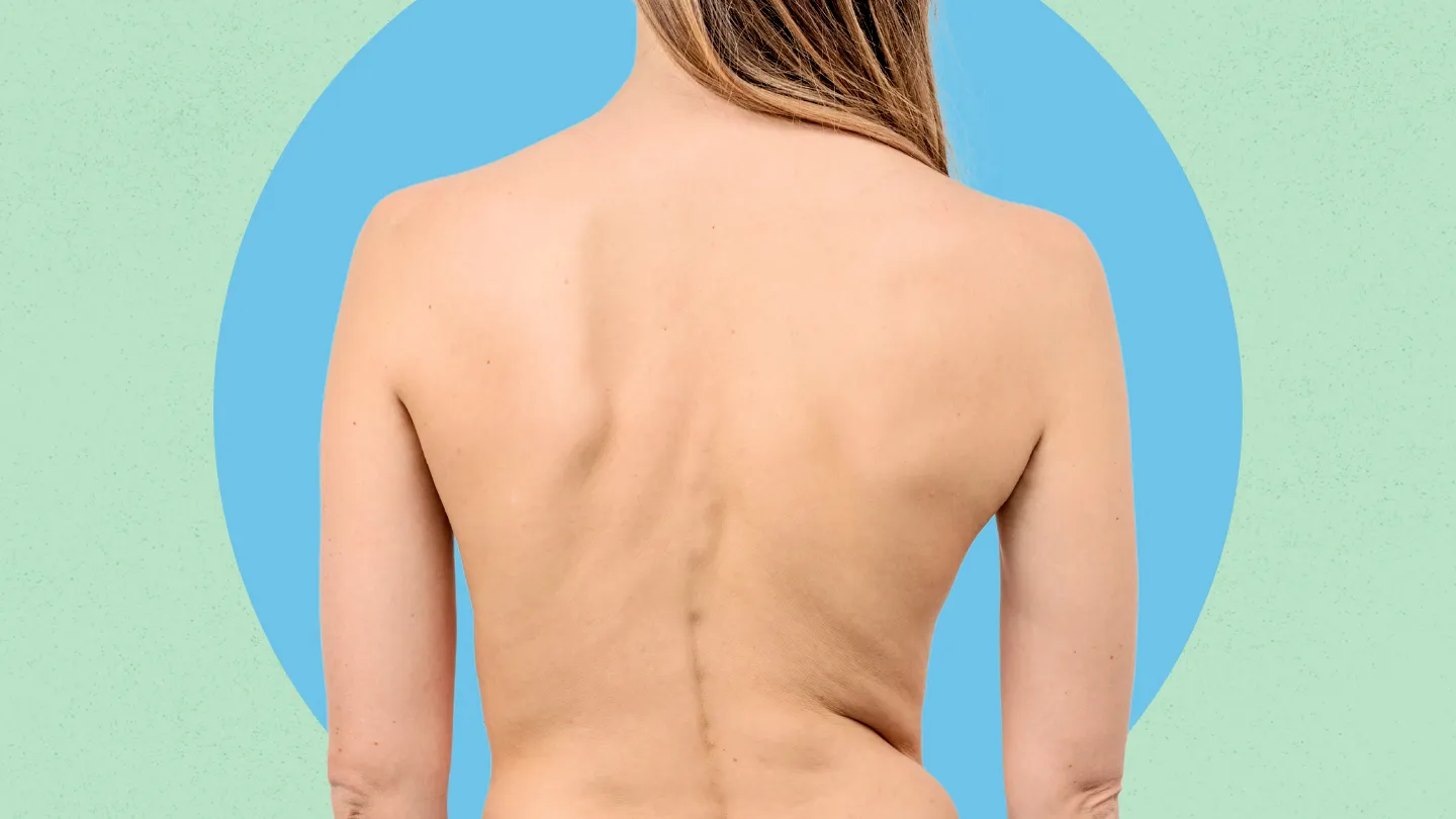 woman rear view showing curved spine