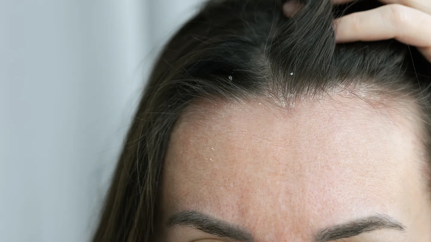 woman with itchy flakey scalp at hairline above forehead