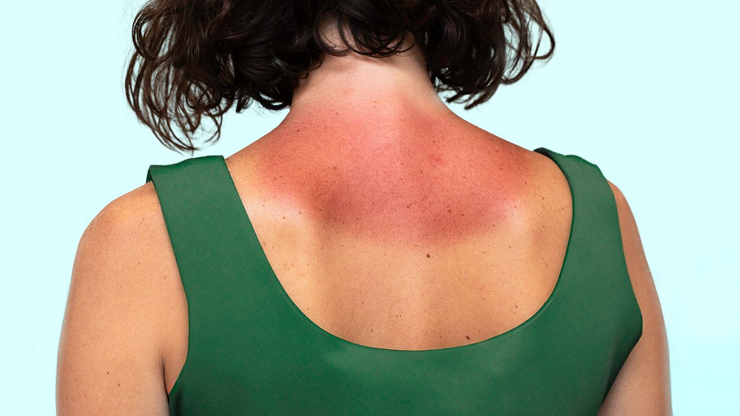 woman in green tank top with sun burn sun poisoning redness on neck