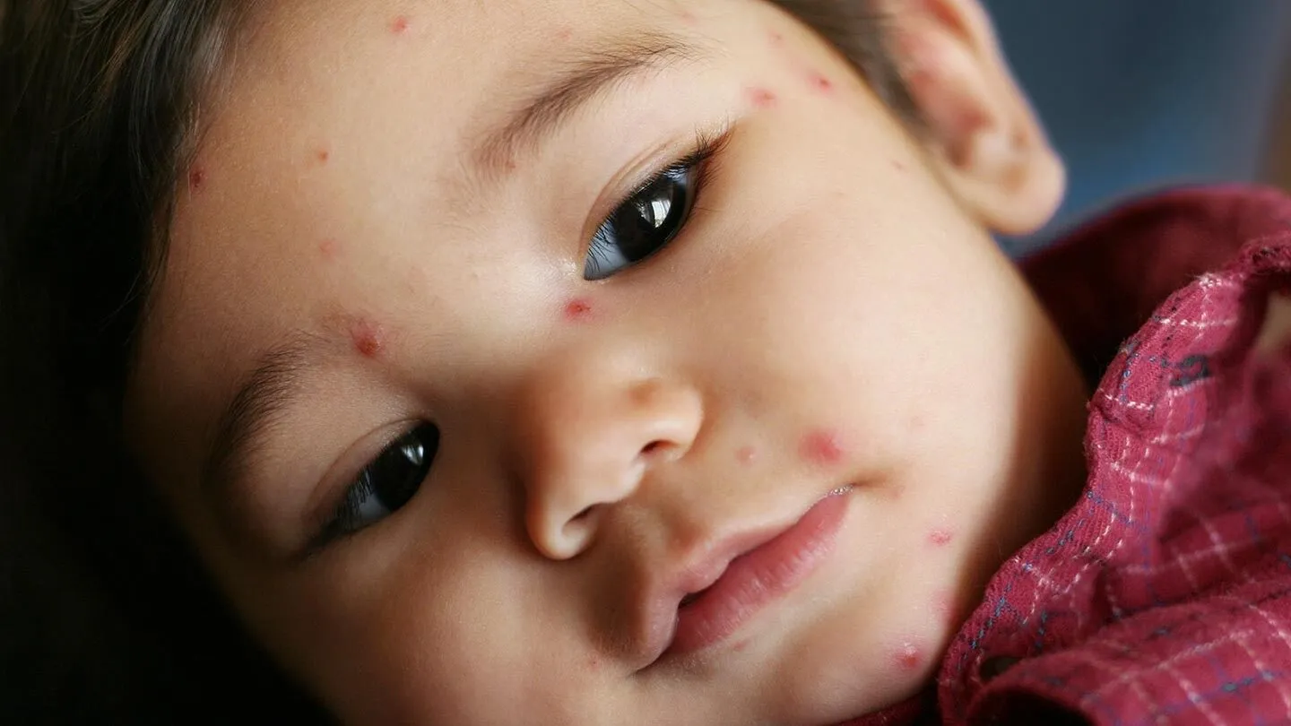 a child with the chickenpox