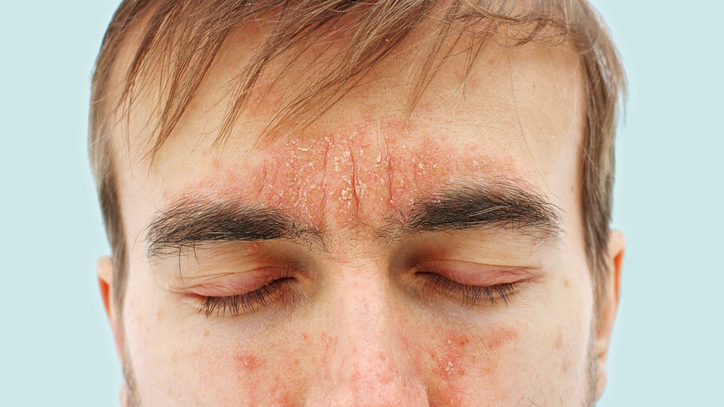 close-up of man who is suffering with facial psoriasis